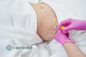Are The Results From Aqualyx Permanent? 1 Do you want to know how long Aqualyx Chard results last?
