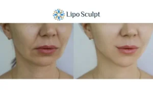 Explaining Total Skin Tightening Treatment And What It Can Do For You 2 Do you want to boost your self confidence? Give Morpheus8 Chard a try today!