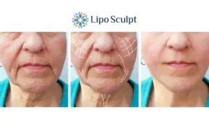 Explaining Total Skin Tightening Treatment And What It Can Do For You 3 Boost your confidence with Morpheus8 Chard call our team today!