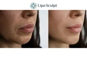 Explaining Total Skin Tightening Treatment And What It Can Do For You 4 Morpheus8 Chard the best results - call our team today!
