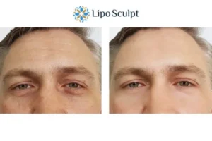 Explaining Total Skin Tightening Treatment And What It Can Do For You 6 Morpheus8 Chard book in today to find out more!